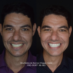 Planejamento realizado para corrigir formato, proporção e tonalidade dos  dentes, preservando a naturalidade do sorriso.
