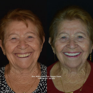 Recuperação da função mastigatória aliada à reconstrução estética do sorriso.