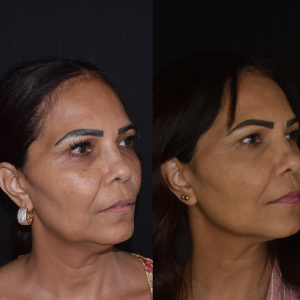 Procedimento realizado para equilibrar as proporções faciais e valorizar a  beleza natural da paciente.
