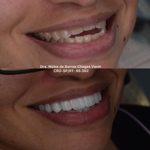 Procedimento realizado para equilibrar as proporções faciais e valorizar a  beleza natural da paciente.
